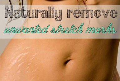 remedies for stretch marks