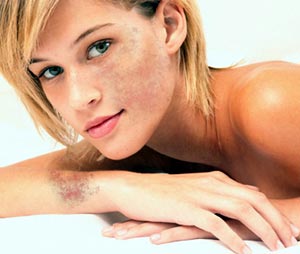 Pigmentation and Dark Spots from Skin