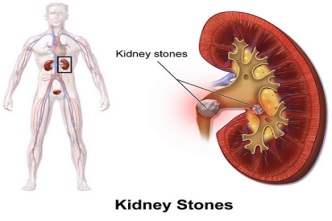 All about Kidney Stones