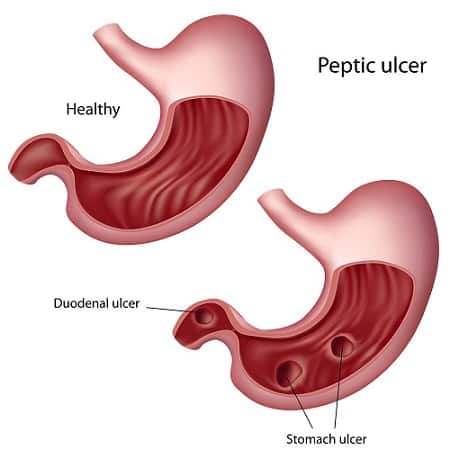 Foods-To-Eat-and-Avoid-If-You-Have-Peptic-Ulcers