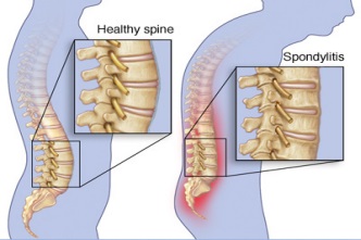 Home Remedies For Spondylosis