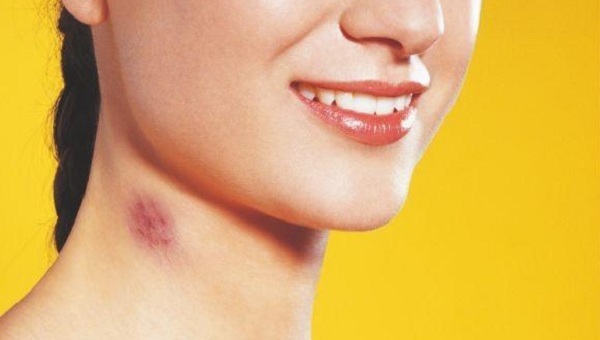 How To Get Rid Of A Hickey