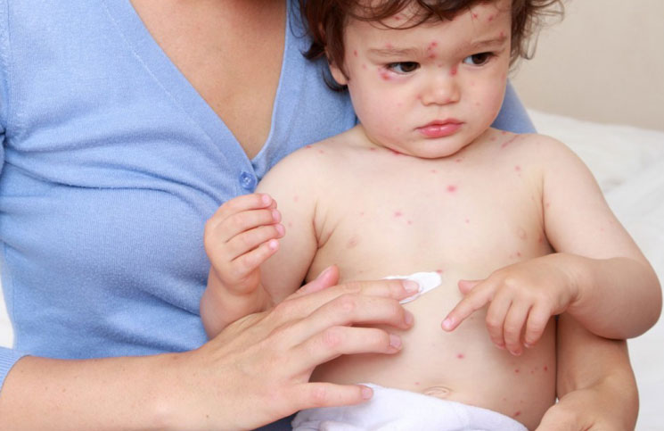 Home-Remedies-for-Chickenpox