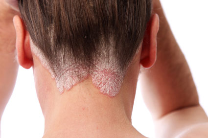 Types of Psoriasis and its triggers and symptoms.