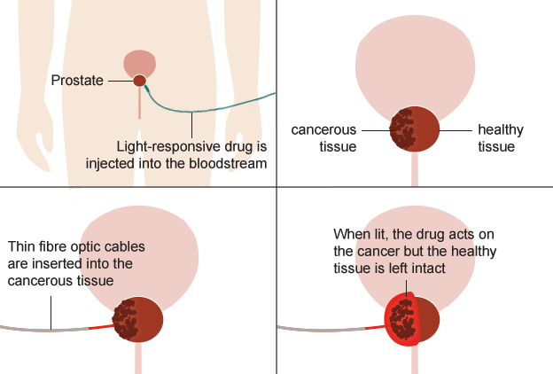 light-therapy-for-prostate-cancer-inlifehealthcare