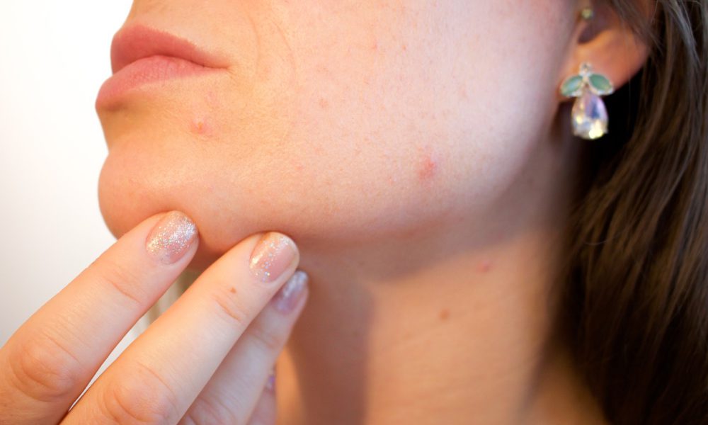 Acne On Your Neck? Here Are The Reasons
