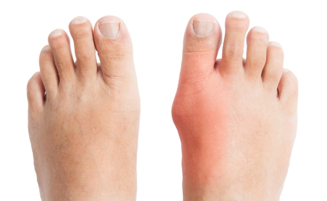 Home remedies for bunion removal