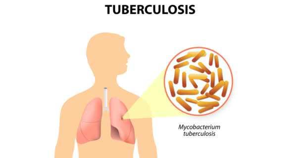 why TB an ancient disease has become today's problem