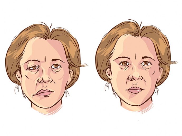 Bell's palsy - What do you know about this condition?