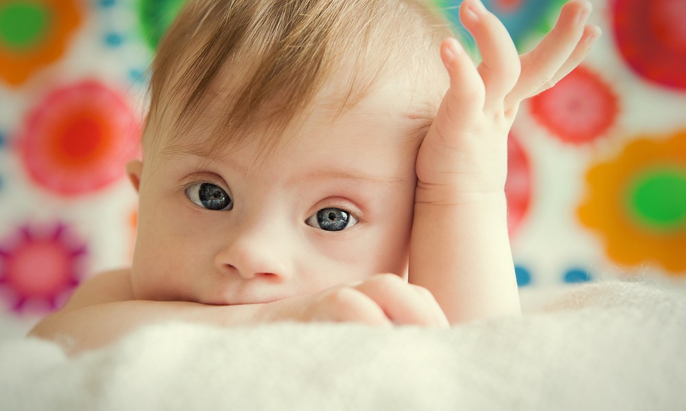 Down syndrome - Causes, symptoms and home treatments