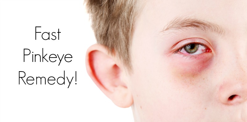 Home remedies for pink eye (Conjunctivitis) in children that works!