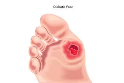 The essential footcare tips for diabetics