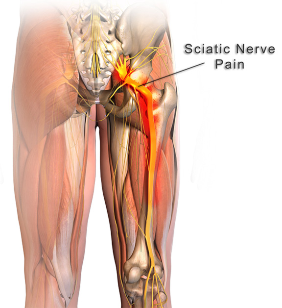 All You Need To Know About Sciatica