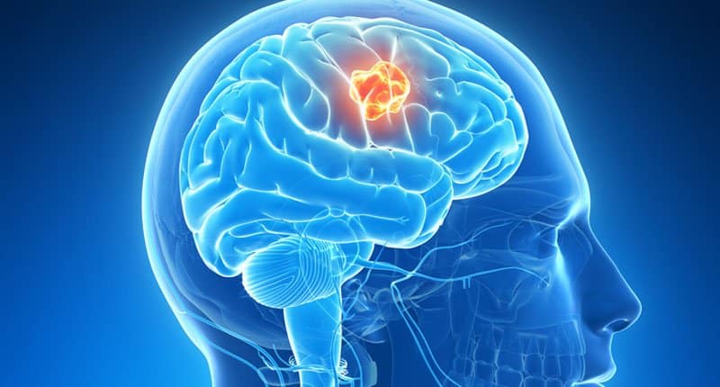 Brain Tumor - Symptoms, risk factors and treatment