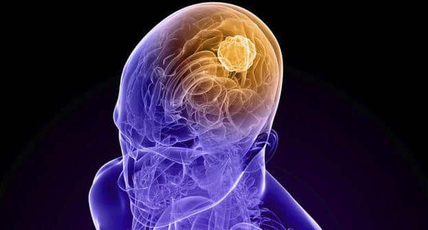How to prevent brain tumor naturally?