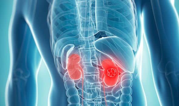 How To Prevent Kidney Diseases ?