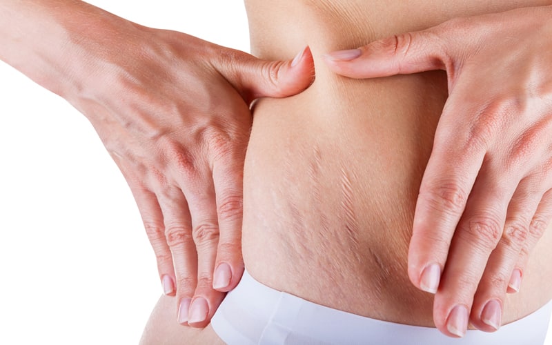 Home Remedies To Get Rid Of Stretch Marks After Pregnancy