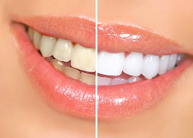 Home Remedies To Whiten Teeth Naturally