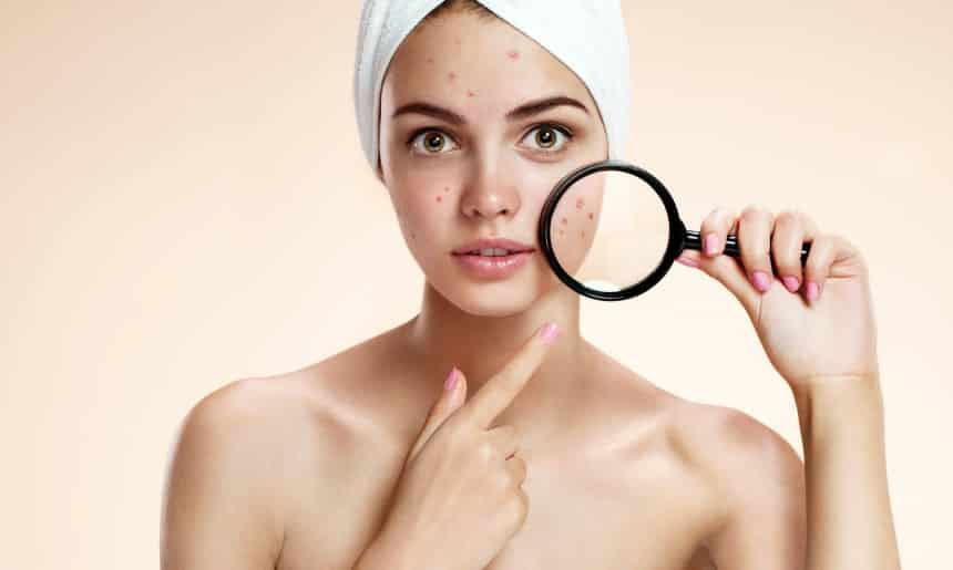 Home Remedies To Treat Acne Scar Permanently