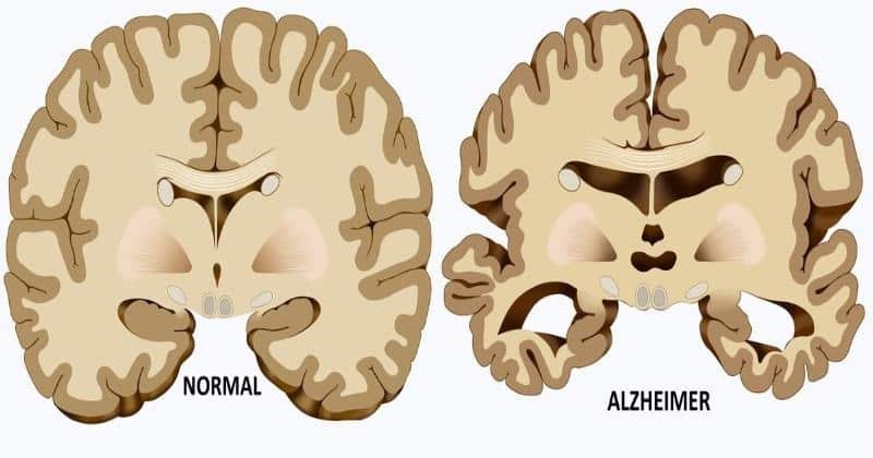Home Remedies To Treat Alzheimer's Disease