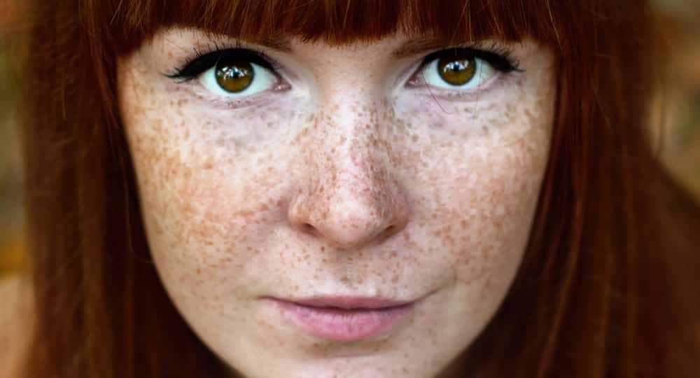 Home Remedies To Treat Freckles