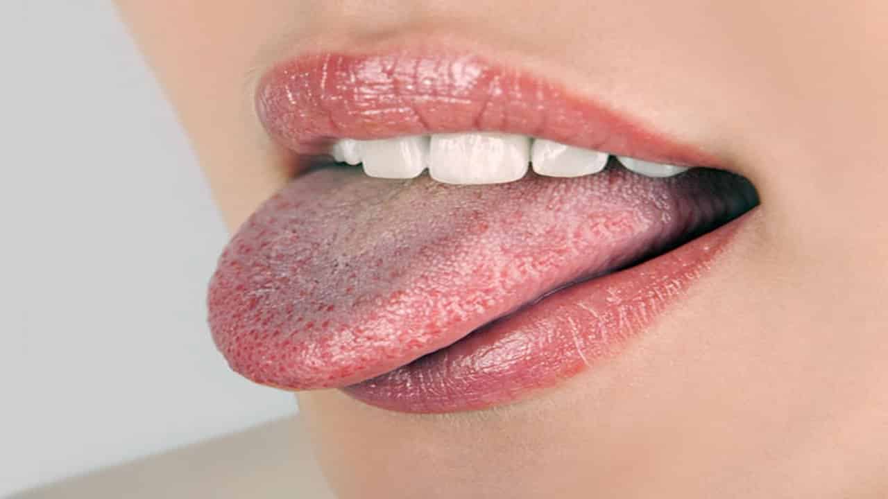 White Tongue
